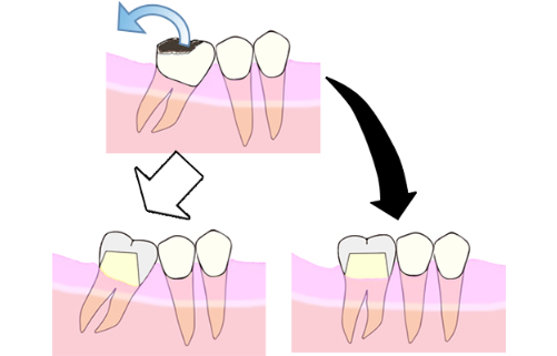 Tilting Tooth with Delivery of Crown