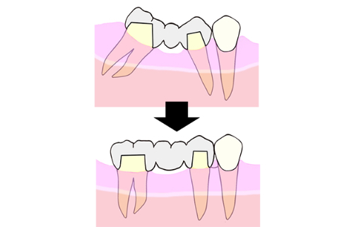 Tilting Adjacent Teeth with Delivery of Bridge