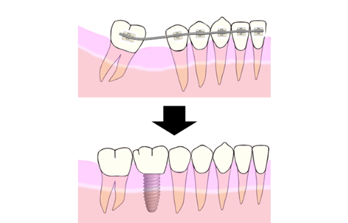 Space Insufficiency of Implant