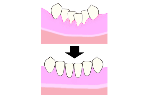 Brushing Difficulty with Tooth Crowding