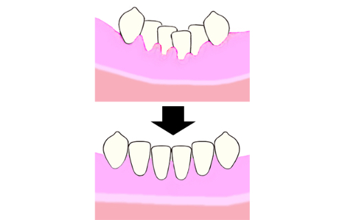 歯並びがガタガタで清掃性が悪い