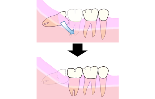 歯の喪失によって生じた隙間を閉じる