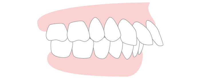骨性暴牙（上顎前突）