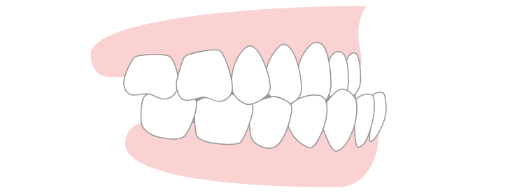 Protruding Lower Jaw