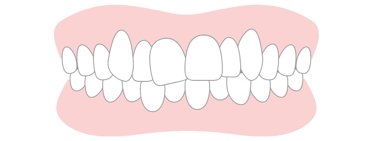 Crowded Teeth (Tooth Irregularities)