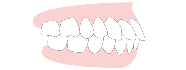 Projecting Teeth (Bimaxillary protrusion)