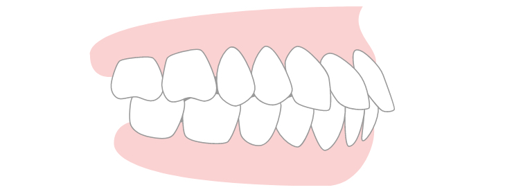 Protruding Teeth/Facial Profile (Bimaxillary Protrusion)