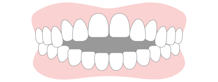 Open Bite (Anterior Open Bite)