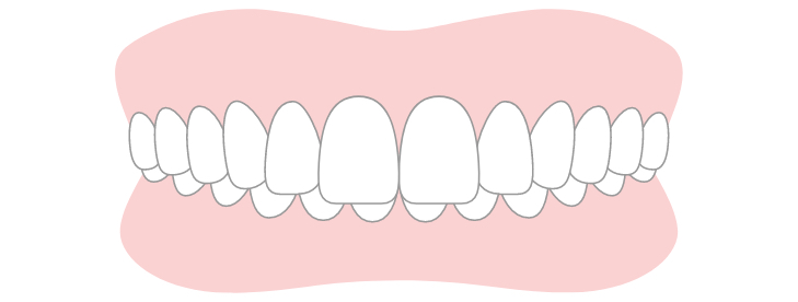 Deep Bite (Excessive Overbite)