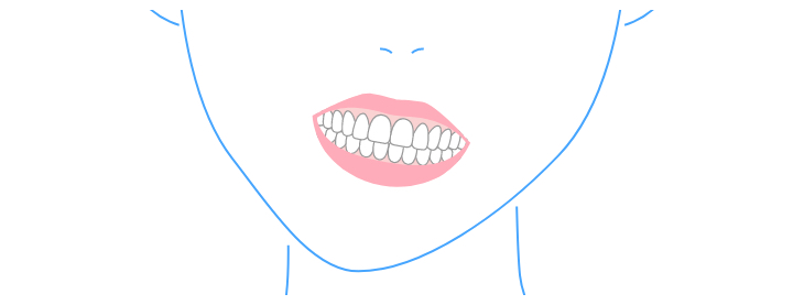 牙齿中线偏掉或颚骨长歪