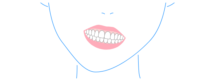 Misaligned Dental Midline or Jaw Shift