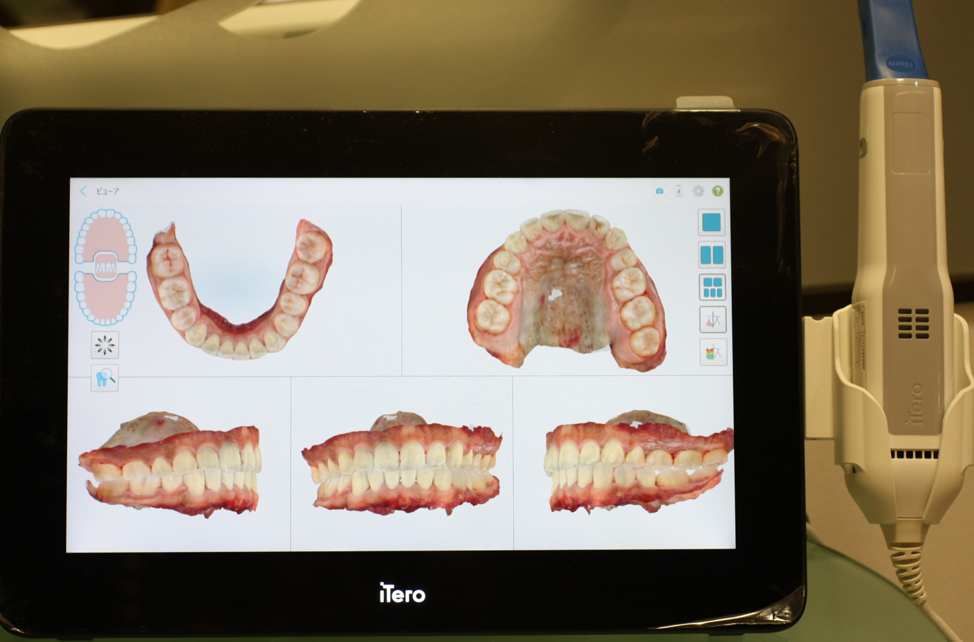 Intraoral Scanner